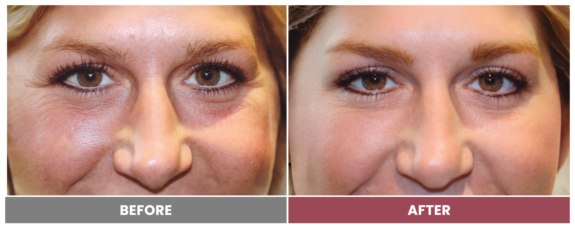 BOTOX FOR WRINKLES & BROW LIFT - Case 3